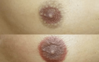 Коричневая корочка на сосках