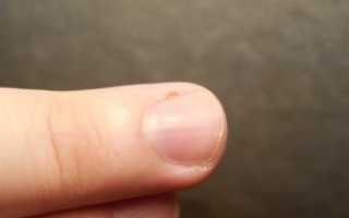 Бордовое пятно у основания ногтя, на кутикуле