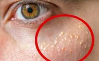Как избавиться от милиумов на лице в домашних условиях