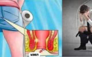 Болит кишечник после того, как сходила в туалет