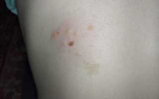 Болячка чешется