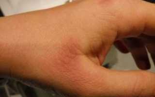 Красные пятна на коже (внешняя сторона ладони)