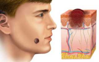 Как остановить рост родинки на носу