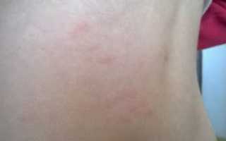 Красные пятна похожие на крапивницу