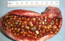 Камни в желчном, фламин вместо одестона