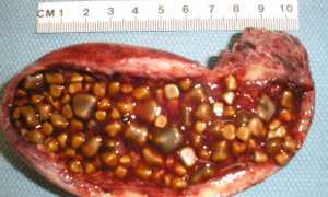 Камни в желчном, фламин вместо одестона