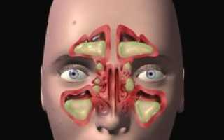 Хронический гайморит