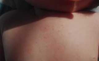 Мелкая сыпь на спине у двух детей и матери