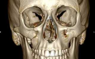 Перелом скуло-орбитального комплекса