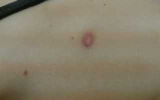 Красное пятно после удаления родинки лазером