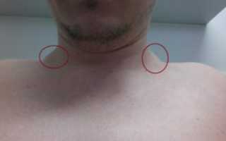 Лимфоузел над ключицей, стоит ли бояться