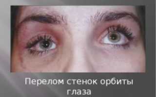 Перелом орбиты глаза