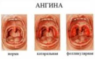 Кашель и сопли через неделю после гнойной ангины