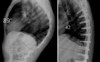 Болезнь Шейермана-Мау
