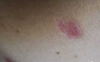 Красное пятно после удаления родинки