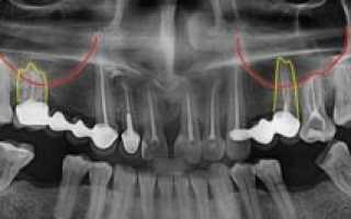 Лечение 26 зуба и гайморова пазуха