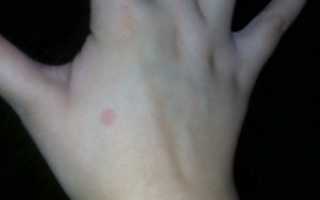 Красные, круглые пятна на руке, небольшие