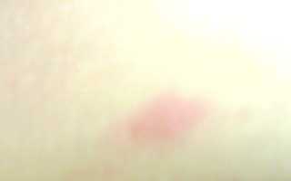 Красные пятна похожие на засовы по всему телу