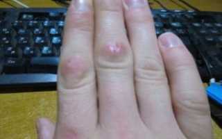 Красные мягкие шишки возле суставов пальца