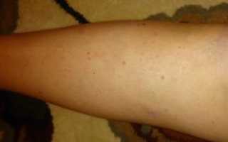 Красные прыщики на ноге