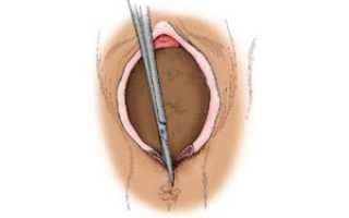 Болит шов после эпизиотомии