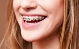 Брекеты и лимфоузлы