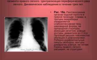 Бурление в легких, расшифруйте диагноз