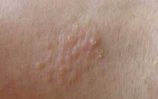 Мелкие бесцветные пупырышки на коже зимой их нет