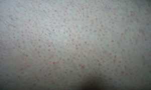 Красные прыщики на ляжках