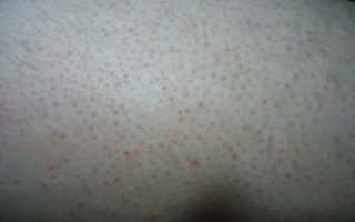 Красные прыщики на ляжках