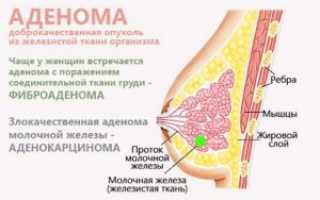 Болит грудь при прикосновении