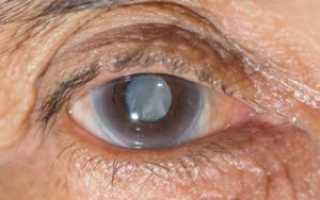 Болит глаз, мутное изображение картинки