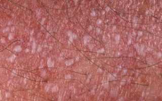 Инфекция на головке члена