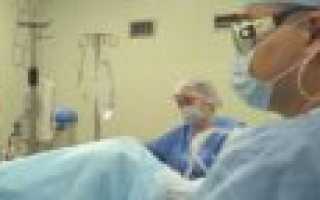 Лазерная абляция мочевого пузыря при лейкоплакии