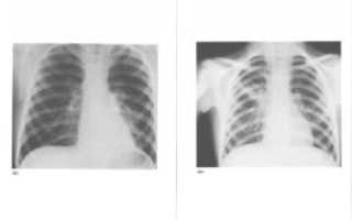 Перибронхиальный отек