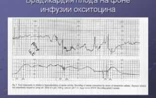 Брадикардия плода