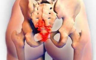 Боль в ягодице во время беременности