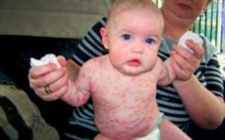 Мастоцитоз у ребёнка в 1 год