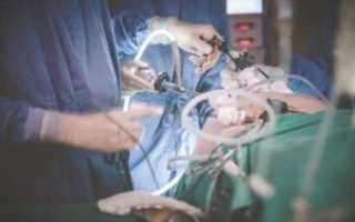 Лапароскопия на желчный при месячных?