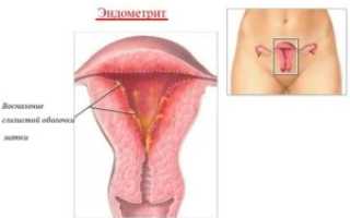 Как вылечить эндометрит и забеременеть?