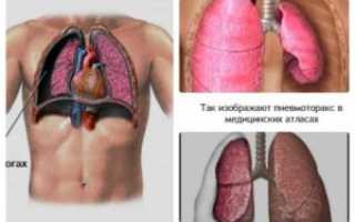 Боли после пневмоторакса