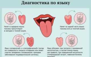 Хронический гастрит и белый налёт на языке