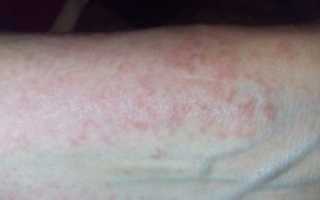 Болит кожа, появилось высыпание