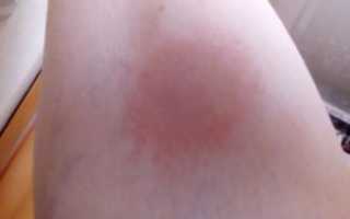 Красные пятна с уплотнением чешутся (шишки)