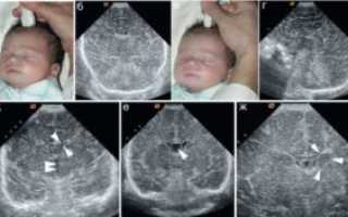 Киста в нейросонографии