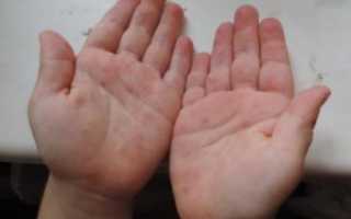 Красные высыпания на ладонях