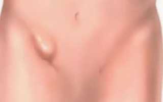 Болезненность в области паха после опер. С лапароскопией через 2 недели