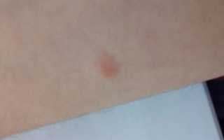 Красное пятно на коже увеличилось