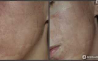 Корочки после лазерной шлифовки