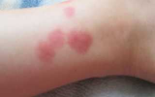 Красно-бордовые пятна на ногах